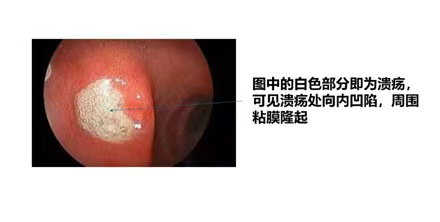 糜烂性胃炎患者该怎么吃，如何吃?生活饮食注意事项大全！(图4)