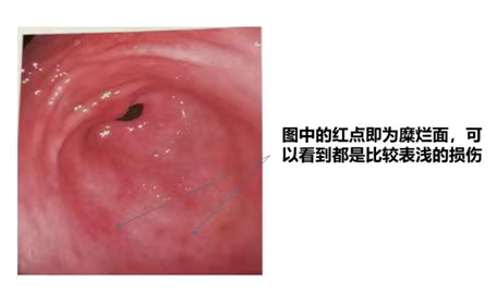 糜烂性胃炎患者该怎么吃，如何吃?生活饮食注意事项大全！(图3)